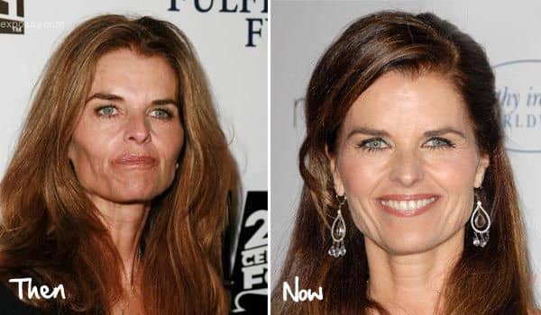 maria shriver before after